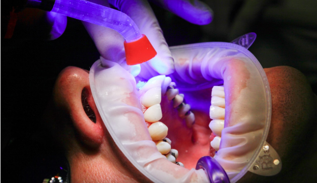 teeth whitening